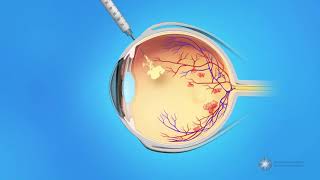 The Five Causes of Macular Degeneration in Detail Dr Alan Mendelsohn [upl. by Sama]