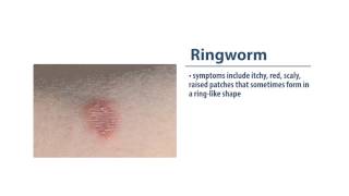 Skin Infections Ringworm [upl. by Nilhtac729]