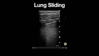 Normal Lung Sliding [upl. by Notled]