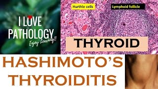 HASHIMOTOS THYROIDITIS Etiopathogenesis Morphology amp Complications [upl. by Ettereve]