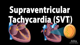 Supraventricular Tachycardia SVT PSVT Animation [upl. by Naam]