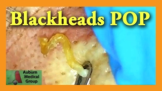 Blackheads POP  Auburn Medical Group [upl. by Eolande]