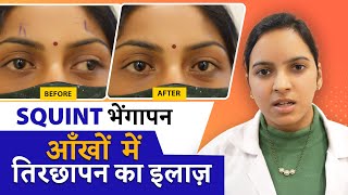 SQUINT  STRABISMUS TREATMENT  आँखों के भैंगापन  तिरछेपन का इलाज [upl. by Yaluz]