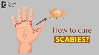 How to cure Scabies  Dr Rajdeep Mysore [upl. by Waxler]