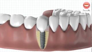 Vidéo de démonstration pour une pose dimplant dentaire [upl. by Gorton306]