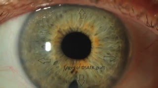 Fuchs Dystrophy amp Corneal Edema [upl. by Verdi]