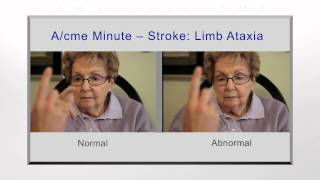 Stroke limb ataxia [upl. by Marthena]