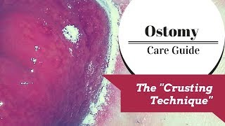 The Ostomy Crusting Technique Explained [upl. by Eedrahs]