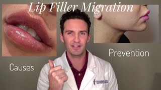 Lip Filler Migration Causes amp Prevention [upl. by Nalorac]