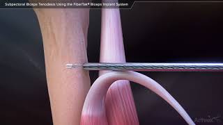 Subpectoral Biceps Tenodesis Using the FiberTak® Biceps Implant System [upl. by Kalli]