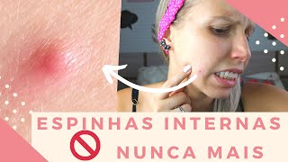 COMO TRATAR ESPINHAS INTERNASFECHADAS  Bruna Harmel [upl. by Nmutua]