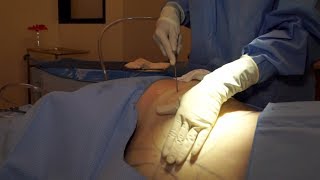 SmartLipo vs Liposuction [upl. by Shurwood8]