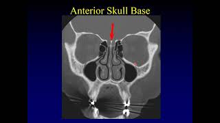 Imaging of the Paranasal Sinuses 1 [upl. by Enar845]