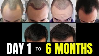 From DAY 1 to 6 MONTHS  Hair Transplant UPDATE Comparison Video [upl. by Ppik]