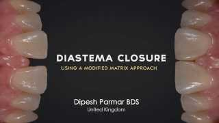 Diastema Closure Perfection  Using a modified matrix approach [upl. by Eneryt]