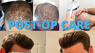 Hair Transplant PostOp Care 101 How To Wash Your Hair After Surgery [upl. by Yessak]