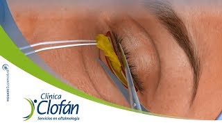 Blefaroplastia o cirugía de párpados  Clínica Clofán [upl. by Schreibman]