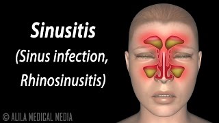 Sinusitis Animation [upl. by Worlock45]